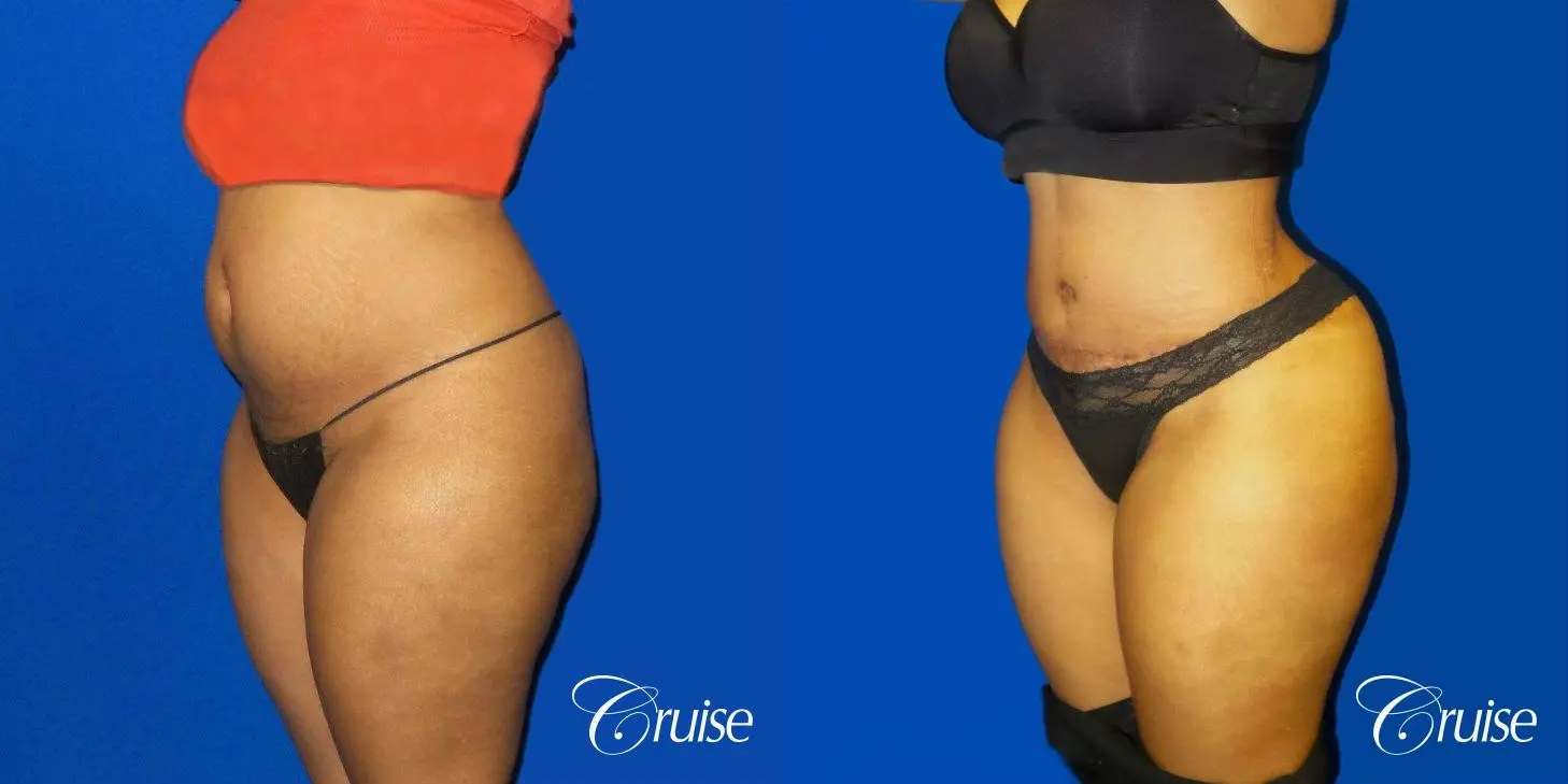 Best Tummy Tuck surgeons Newport Beach - Before and After 2