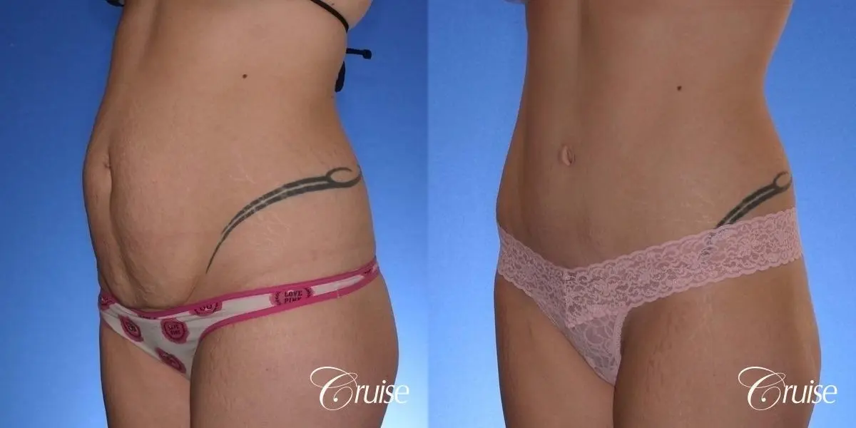 Tummy Tuck: Patient 38 - Before and After 3