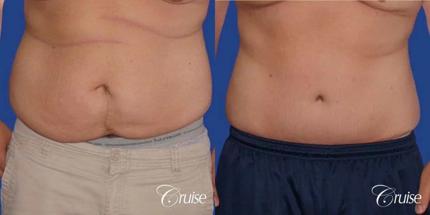best before and after tummy tuck gallery male - Before and After 1