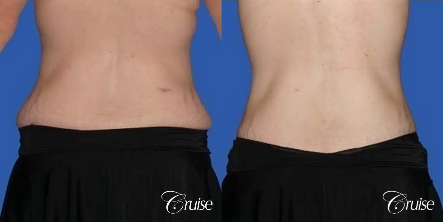 best plastic surgeon for extended tummy tuck after weight loss - Before and After 4