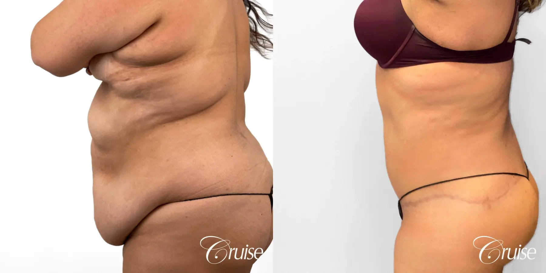 Tummy Tuck: Patient 79 - Before and After 3