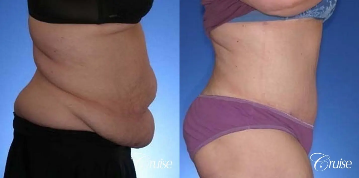 best before and after pictures of extended tummy tuck scar - Before and After 5