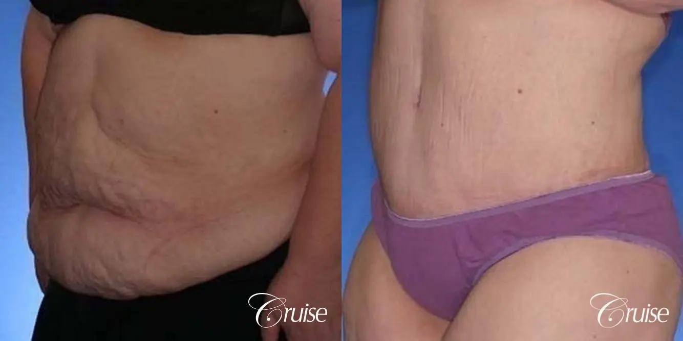best before and after pictures of extended tummy tuck scar - Before and After 2