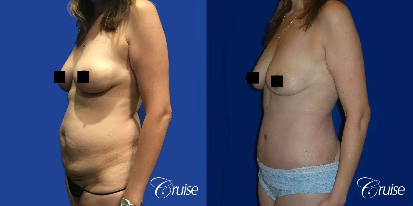 Best tummy tuck incisions orange county - Before and After 2