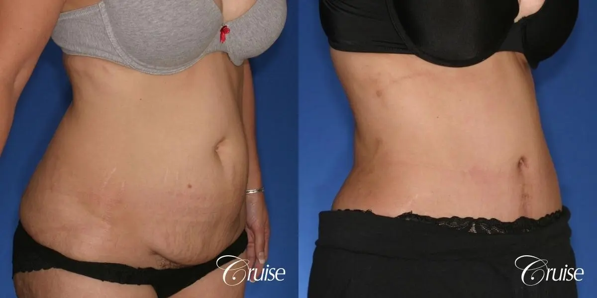 Tummy Tuck - Standard Incision - Before and After 3