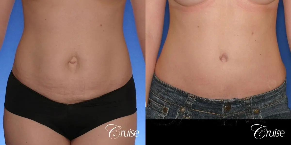 Tummy Tuck: Patient 38 - Before and After 1