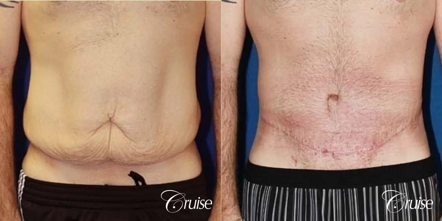 Best male circumferential tummy tuck - Before and After 1