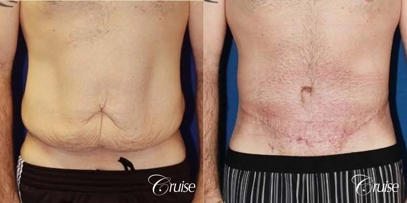 Tummy Tuck Before & After Gallery: Patient 27