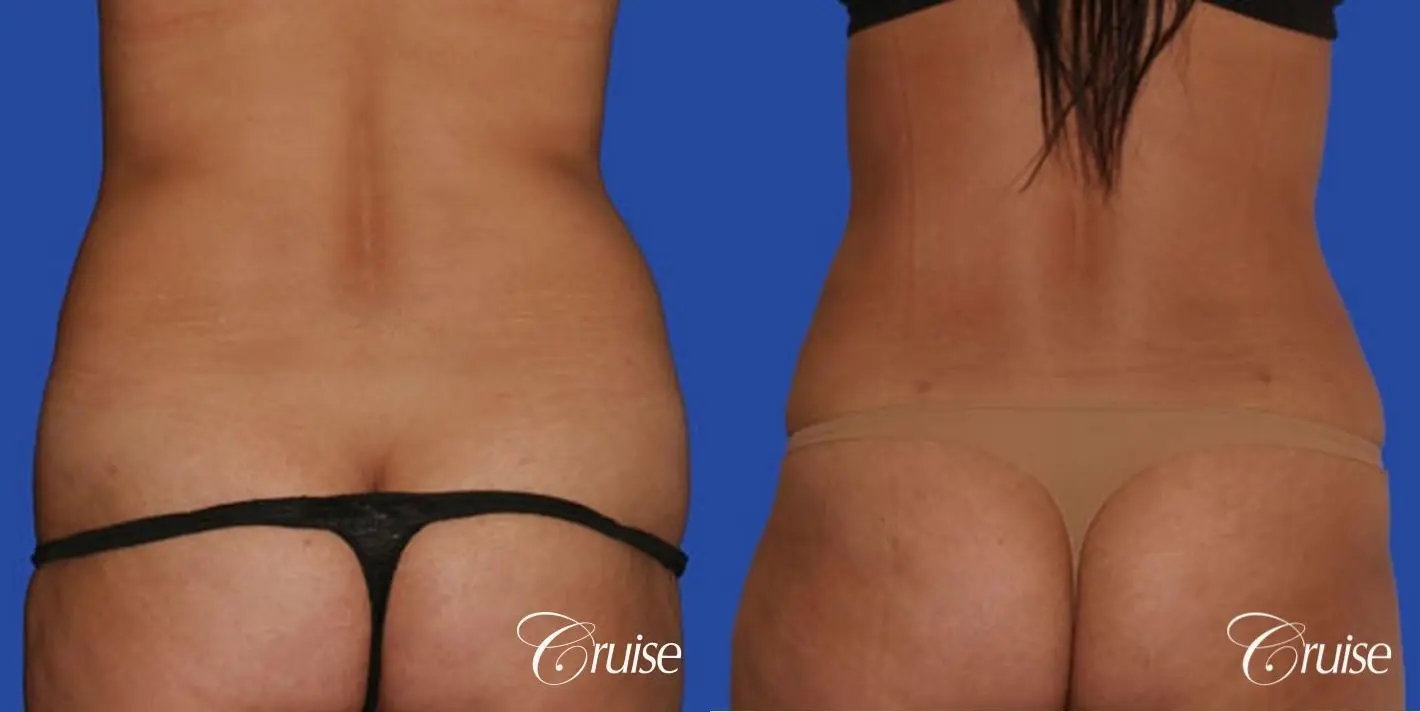 best standard abdominoplasty tummy tuck with top surgeon - Before and After 3