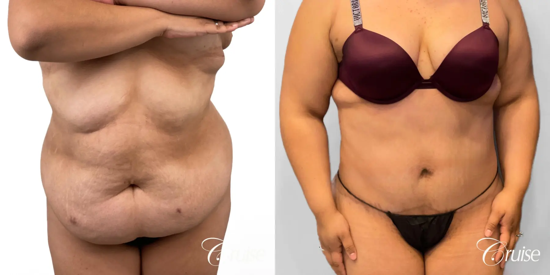 Tummy Tuck: Patient 79 - Before and After 1