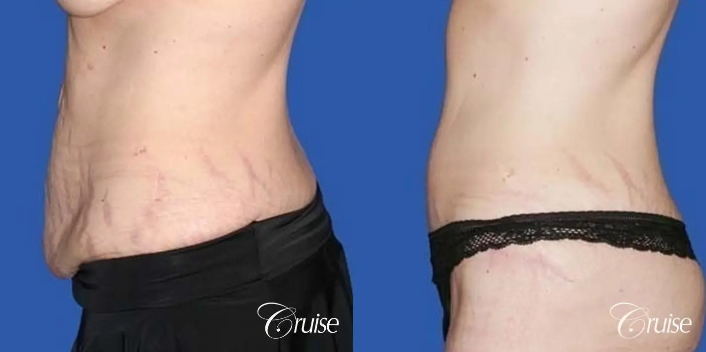 best plastic surgeon for extended tummy tuck after weight loss - Before and After 3