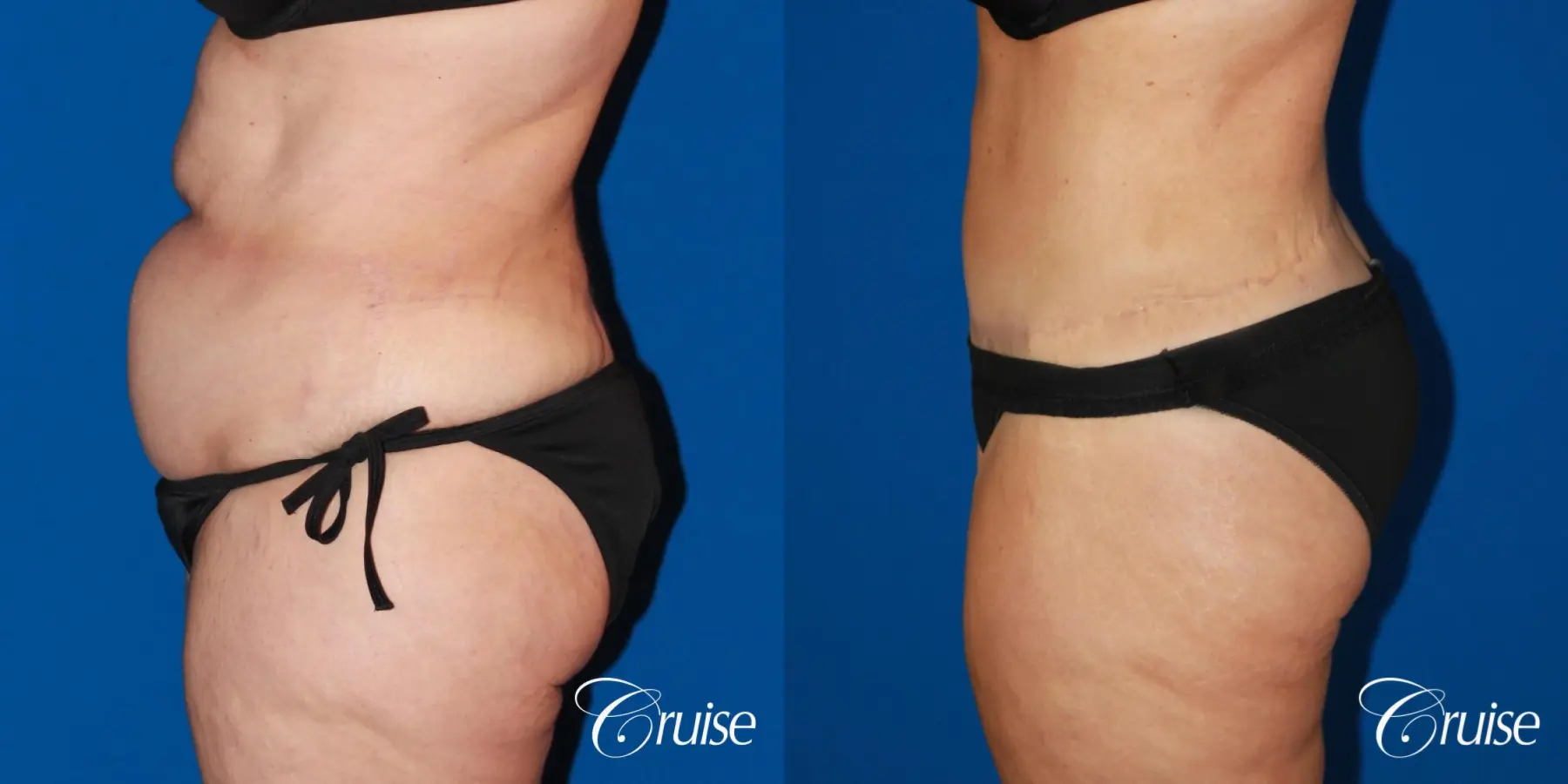 Tummy Tuck: Patient 80 - Before and After 5