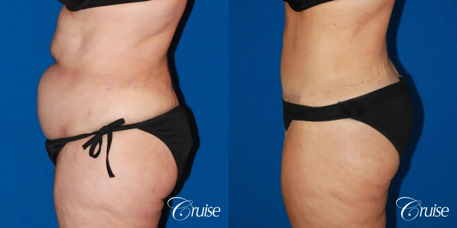 Tummy Tuck: Patient 86 - Before and After 5