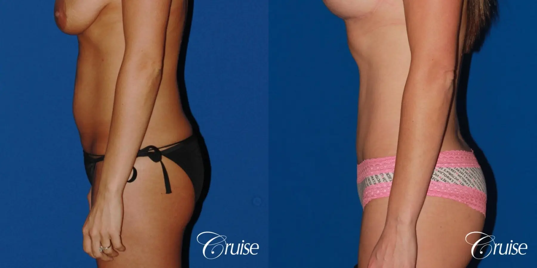 Standard Tummy Tuck & Liposuction: 35 Yr Old Female - Before and After 2