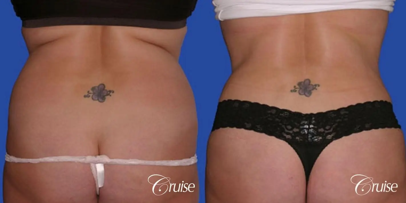 Tummy Tuck Before & After Gallery: Patient 45