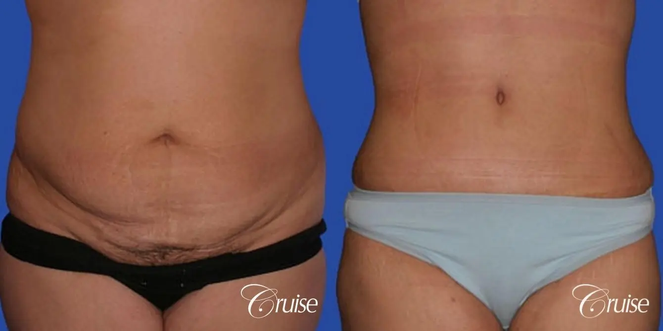 before and after tummy tuck pictures plastic surgeon - Before and After 1
