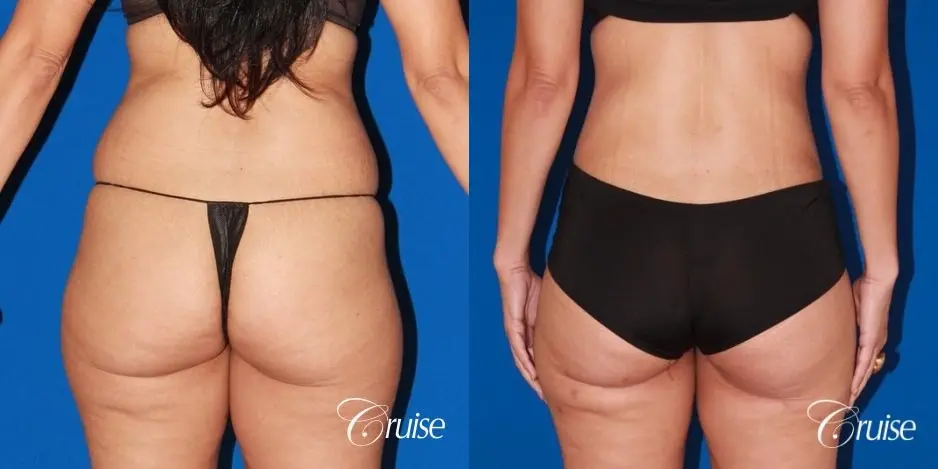 Tummy Tuck & Liposuction: 41 Yr Old Female  - Before and After 3