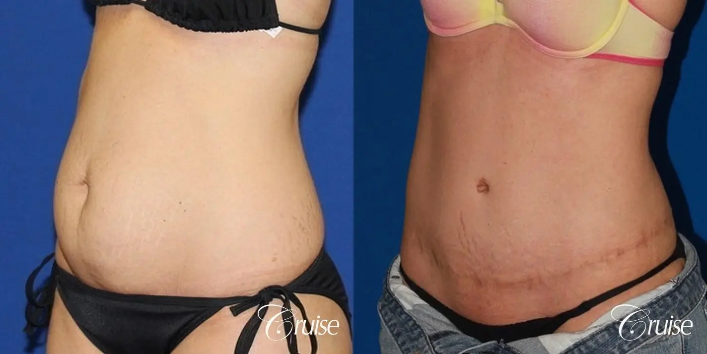 best extended tummy tuck on skinny patient - Before and After 3