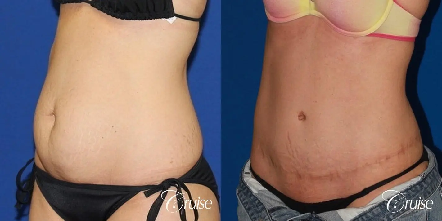 Tummy Tuck Before & After Gallery: Patient 66