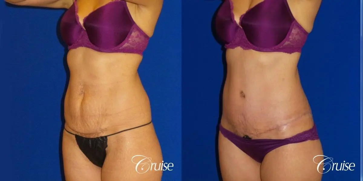 Tummy Tuck Extended Incision - Before and After 2