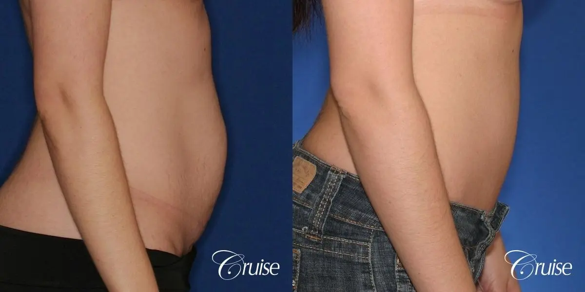 Tummy Tuck: Patient 38 - Before and After 2