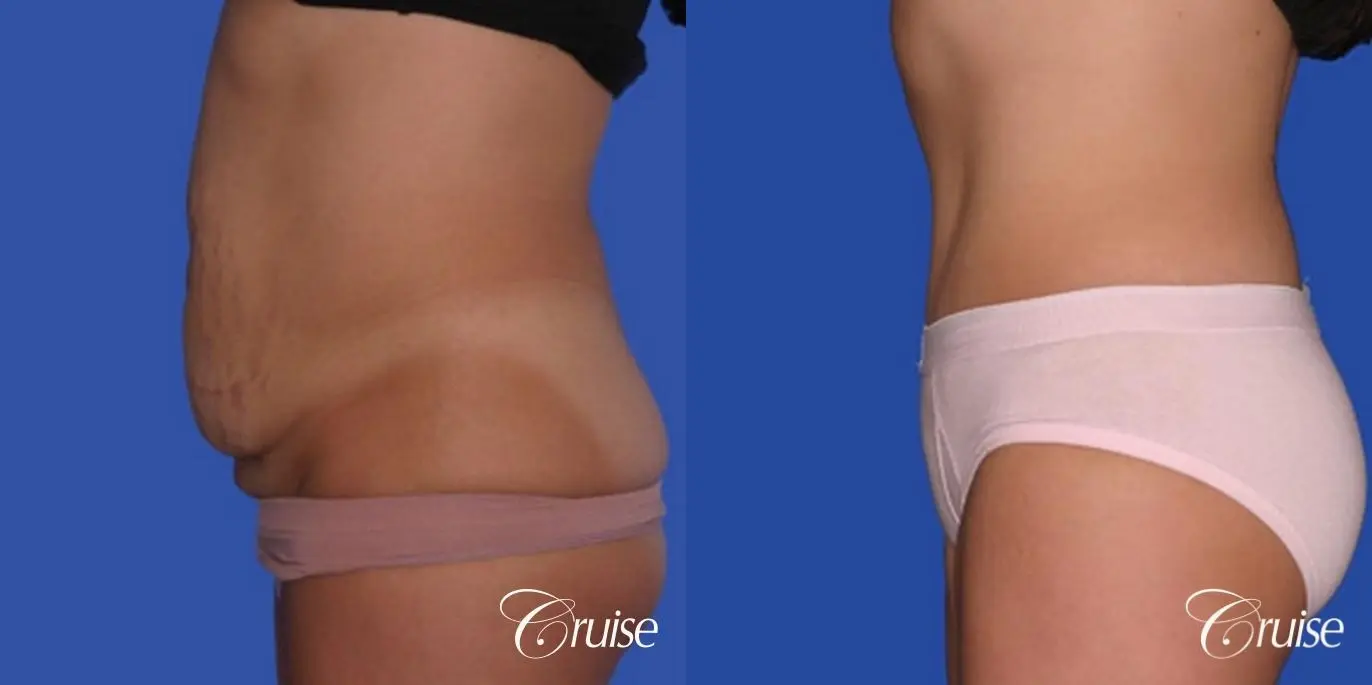 best pics of tummy tuck low scar - Before and After 2
