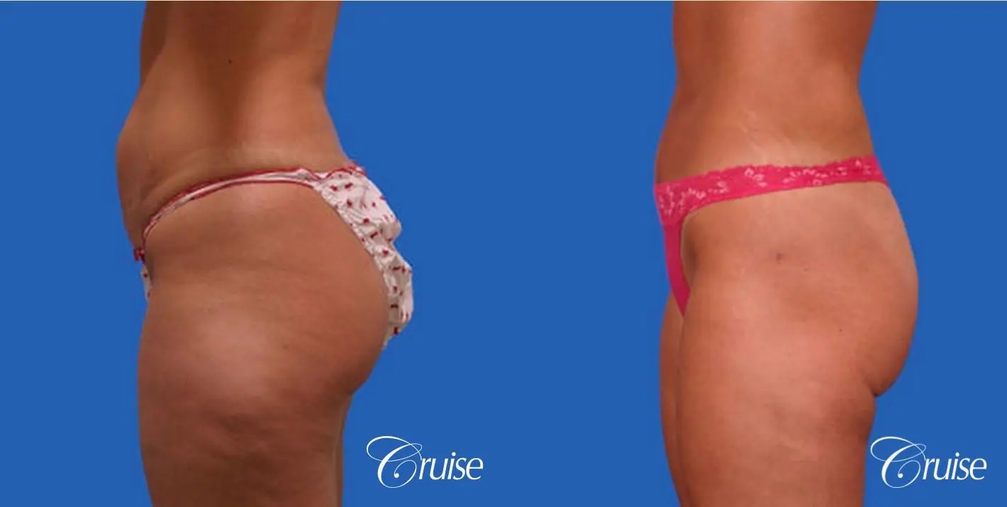 best pictures of mini tummy tuck for skin only on skinny female - Before and After 2