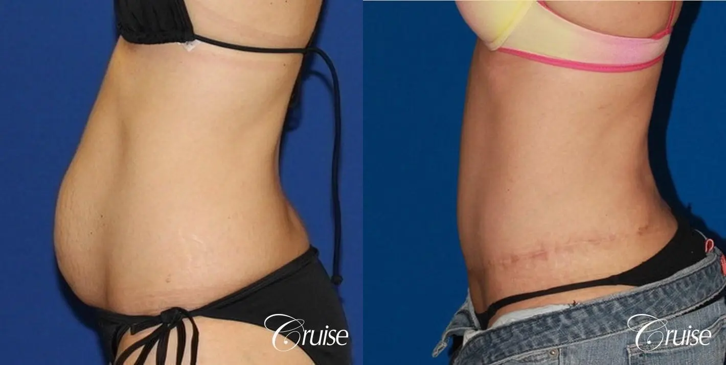 best extended tummy tuck on skinny patient - Before and After 2