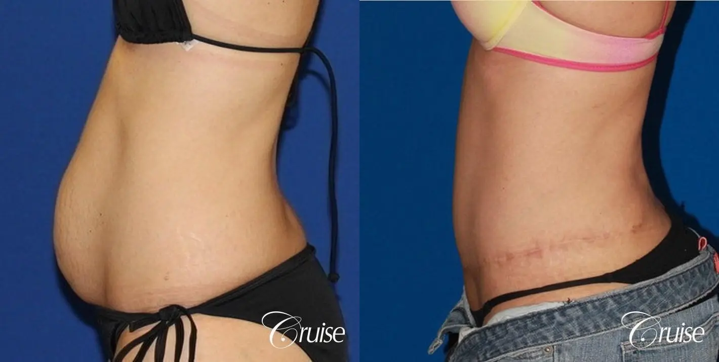 Before and After Tummy Tuck