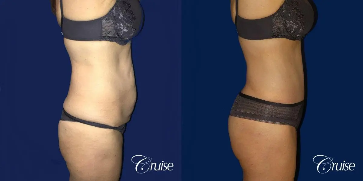 Liposuction & Tummy Tuck Extended Incision  - Before and After 3
