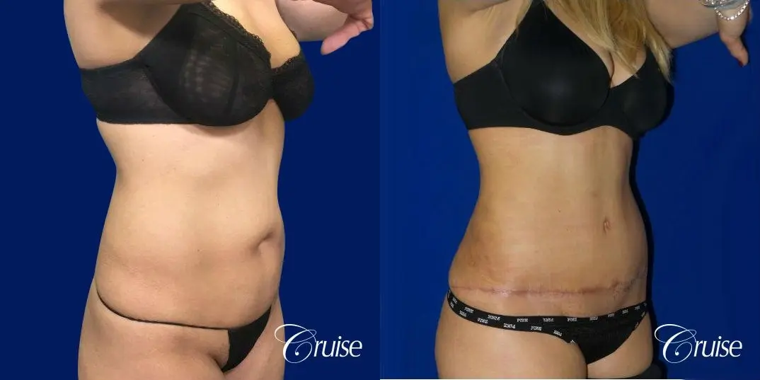 Tummy Tuck Standard Incision - Before and After 5