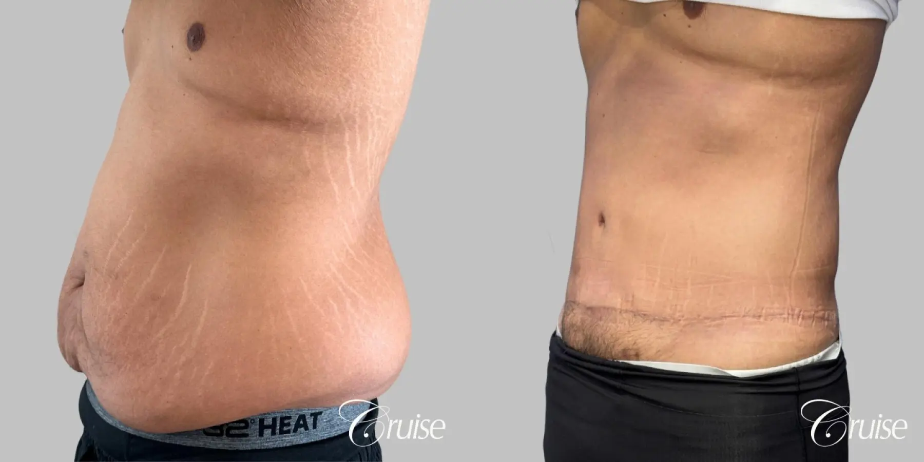 Male Tummy Tuck - Circumferential - Before and After 3