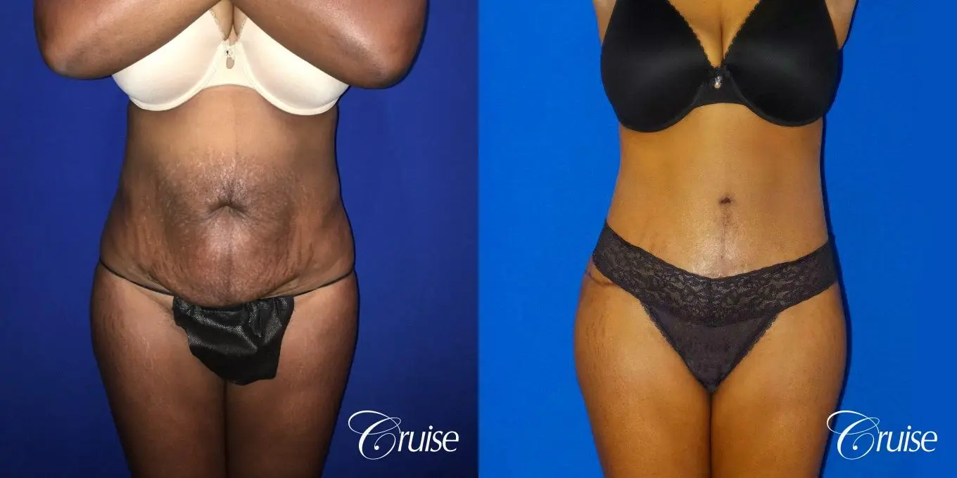 Tummy Tuck Before & After Gallery: Patient 1