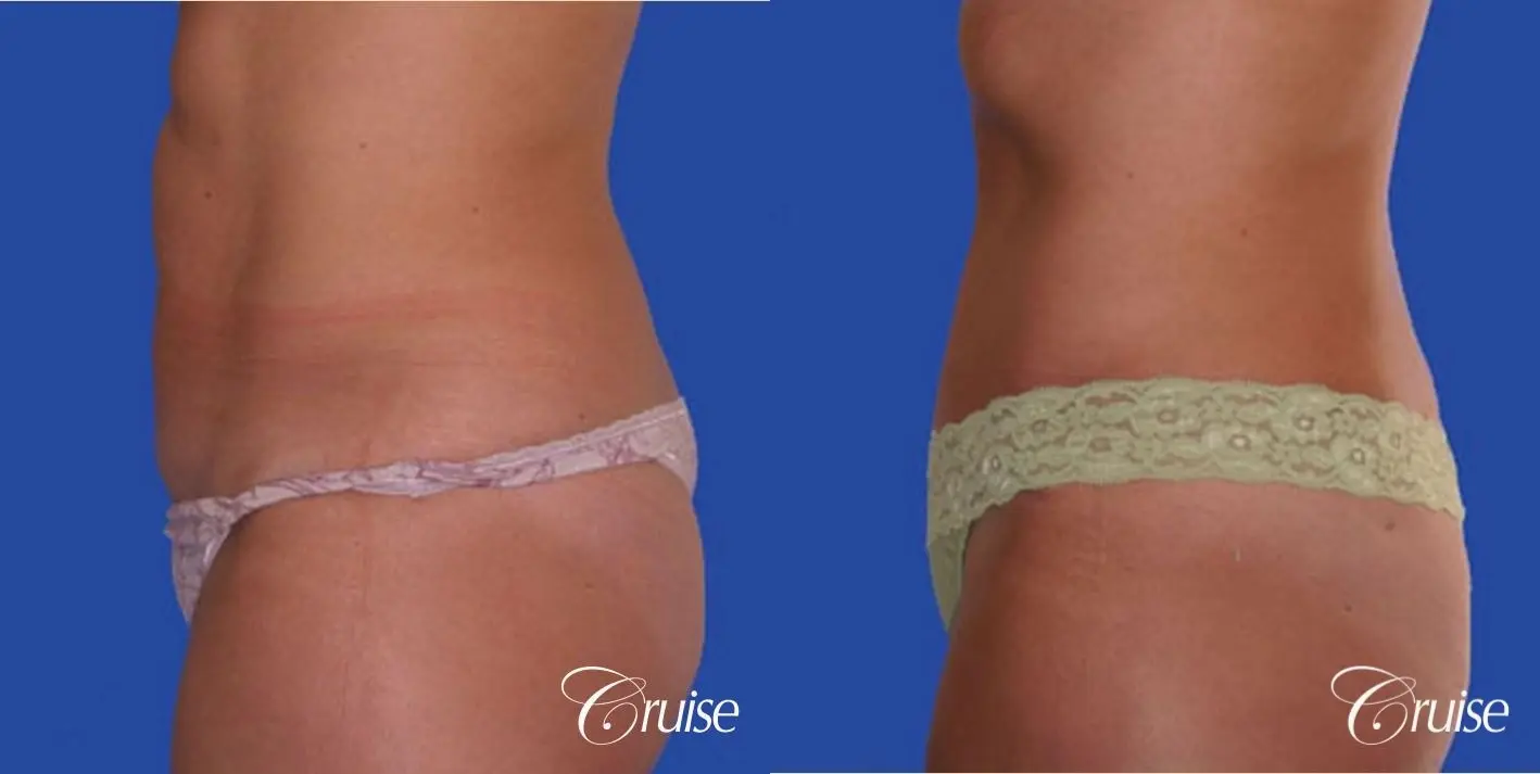 best 41 year old tummy tuck results and pictures - Before and After 2