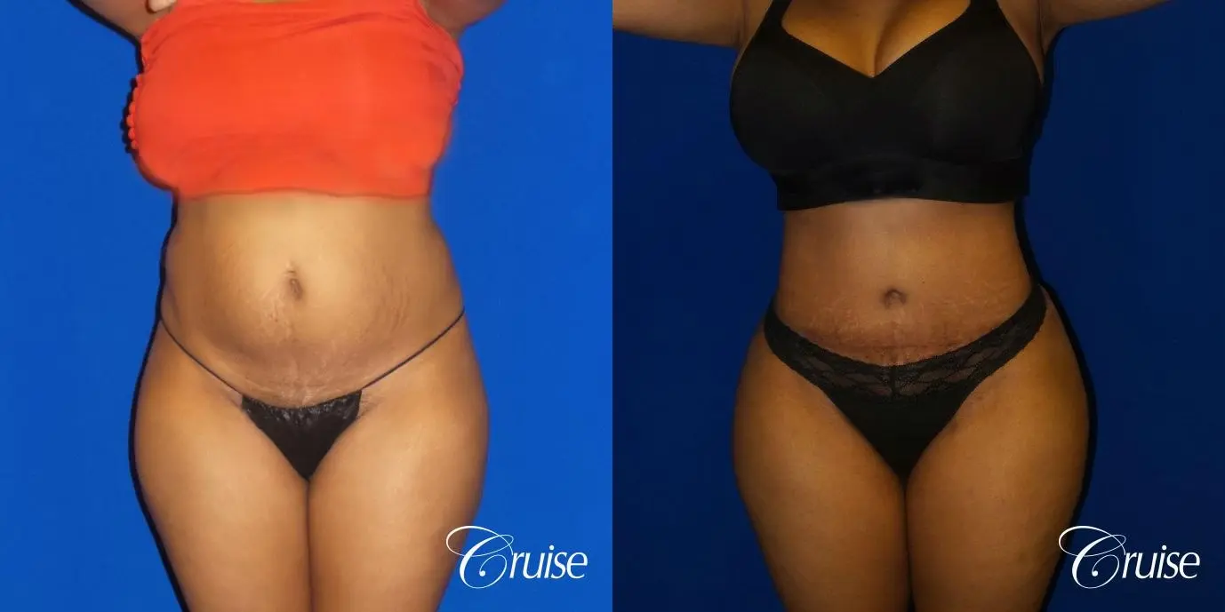 Best Tummy Tuck surgeons Newport Beach - Before and After 1