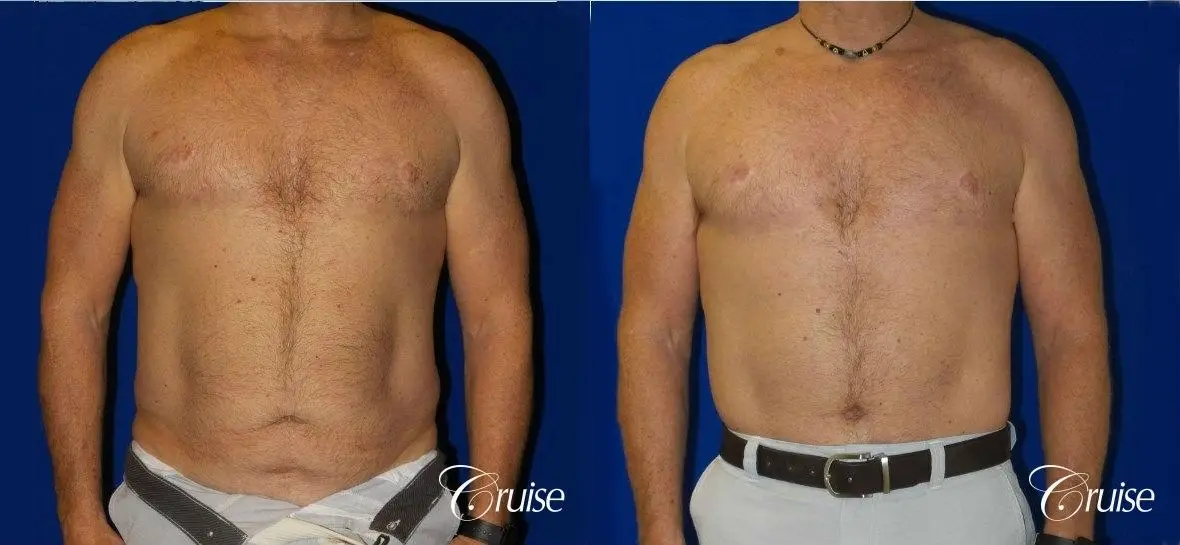 Standard Tummy Tuck & Liposuction: 54 Yr Old Male - Before and After 1