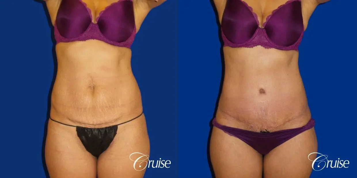 Tummy Tuck Extended Incision - Before and After  