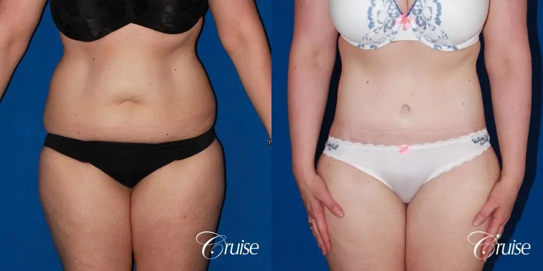 35 Yr Old Female  with Circumferential Tummy Tuck & Liposuction - Before and After 1