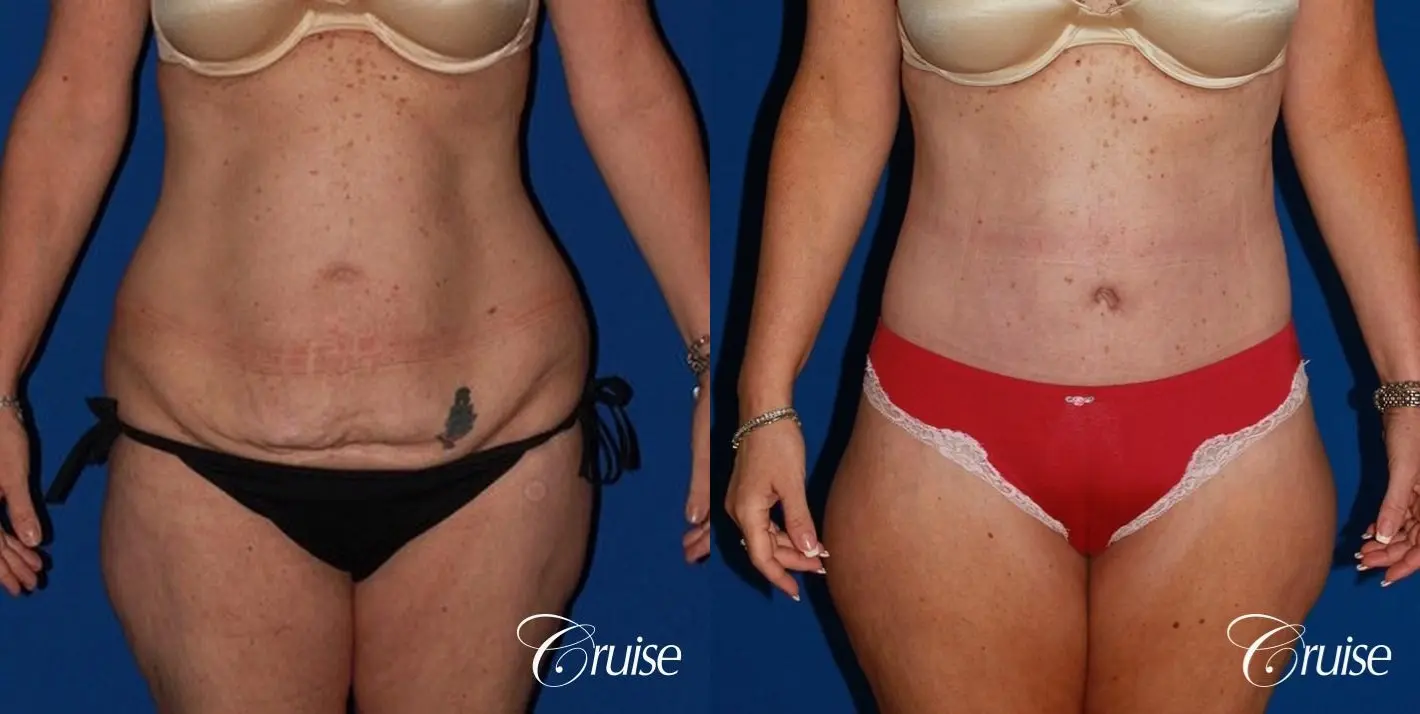 best circumferential body lift tummy tuck scar - Before and After 1