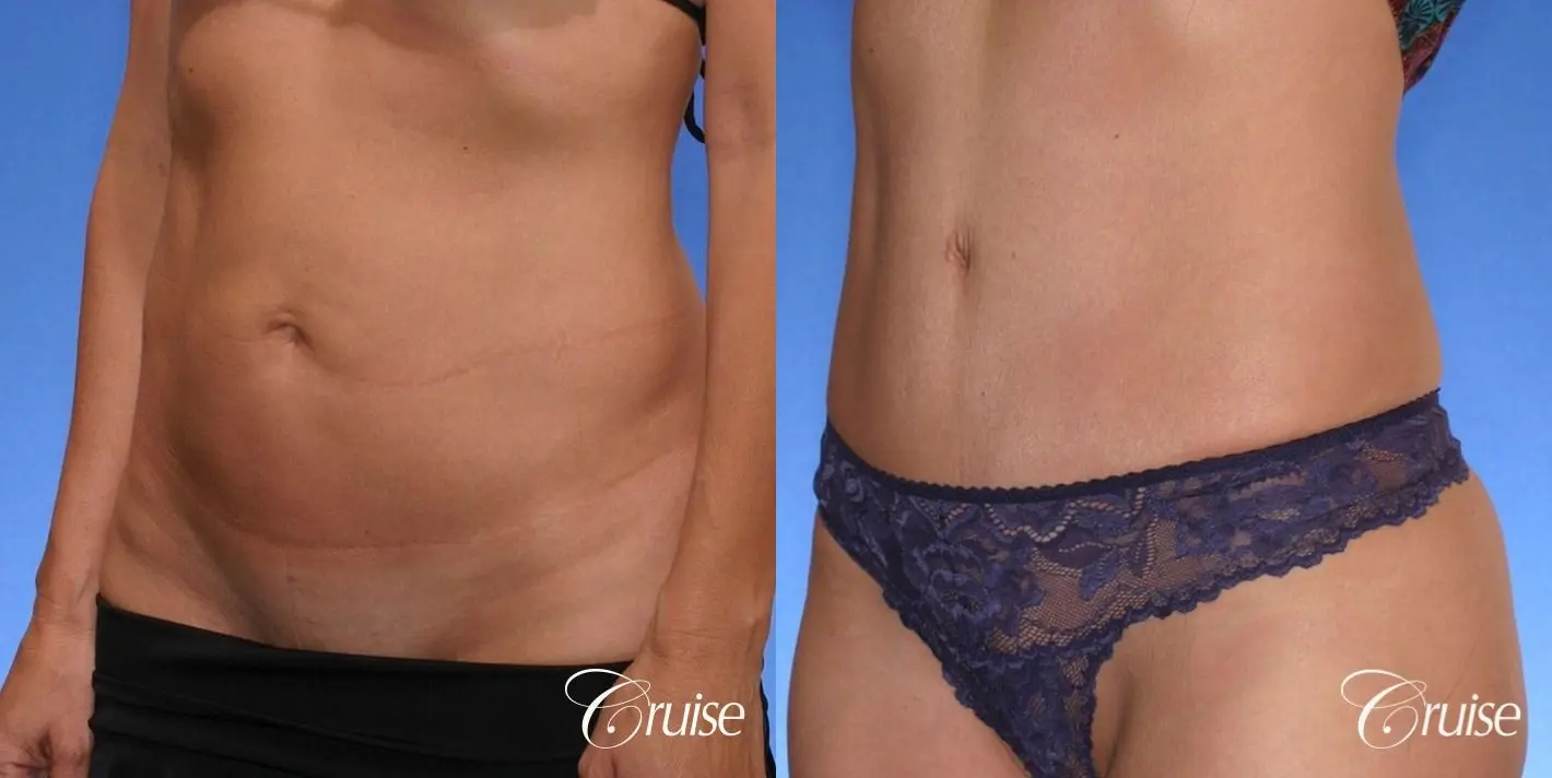 best scar on thin female tummy tuck patient - Before and After 1