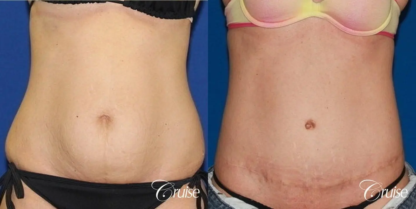 Tummy Tuck (Abdominoplasty), Woman - Age 40 - Before & After Photos