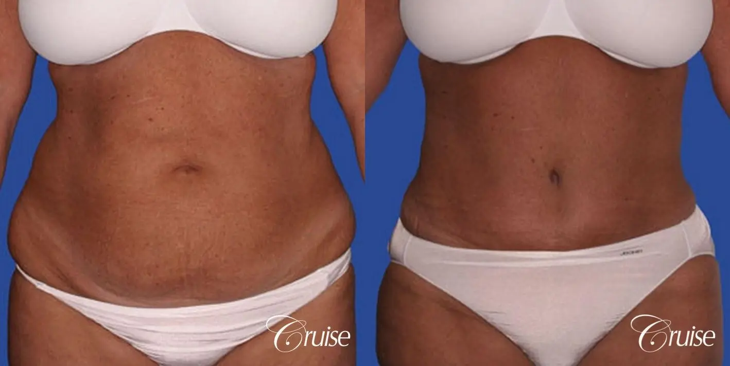 best tummy tuck with liposuction flanks at 50 years old - Before and After 1