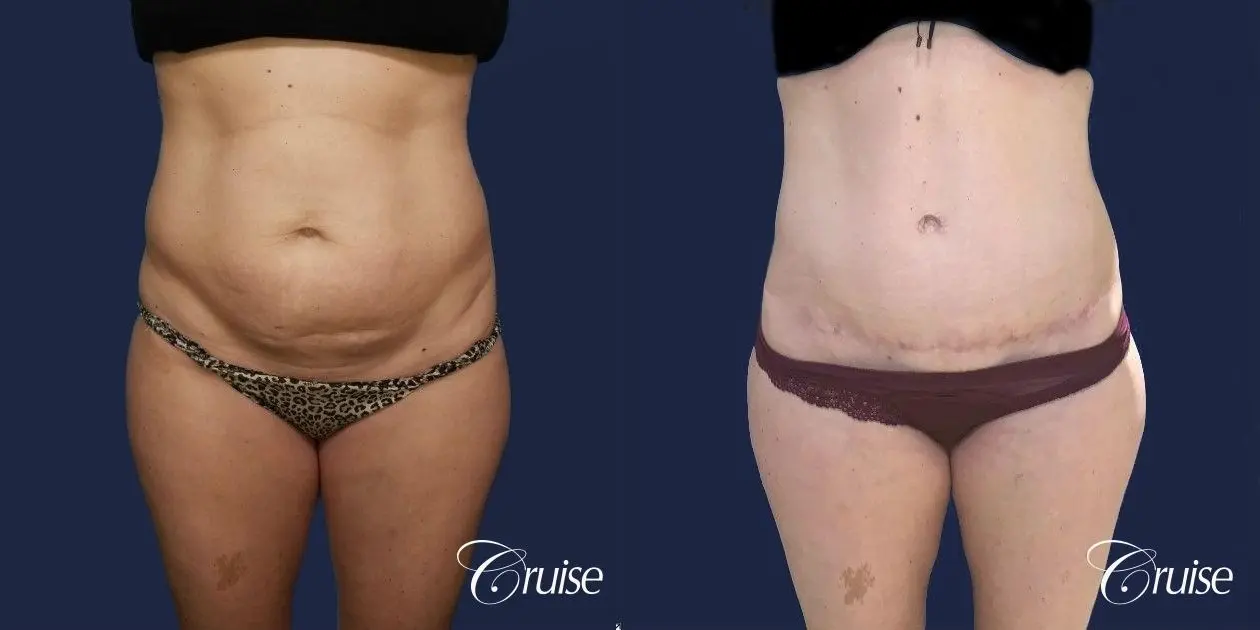 Standard Tummy Tuck - Before and After  