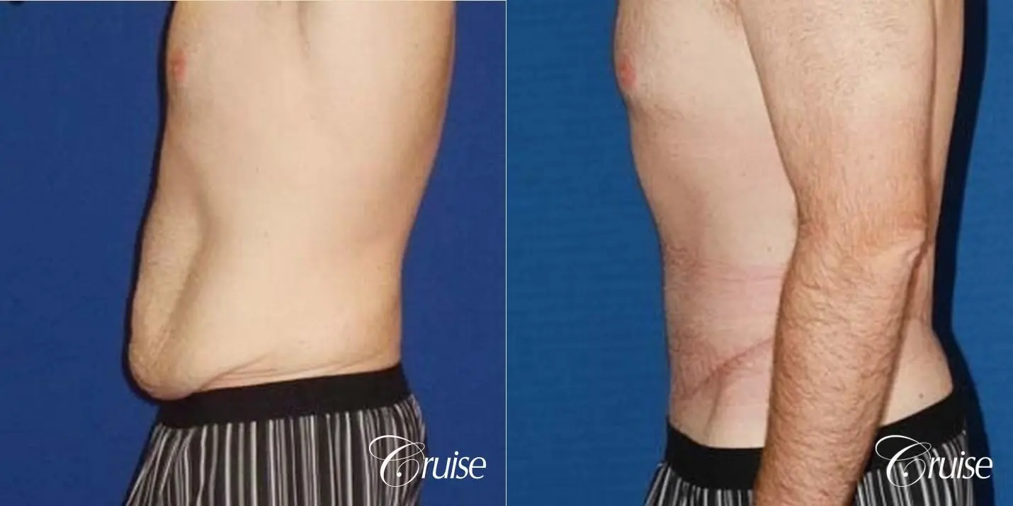 Best male circumferential tummy tuck - Before and After 2