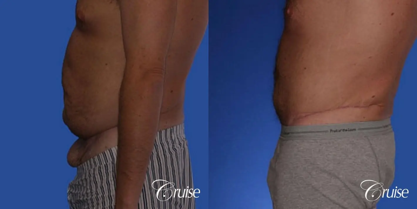best male extended male abdominoplasty tummy tuck - Before and After 2