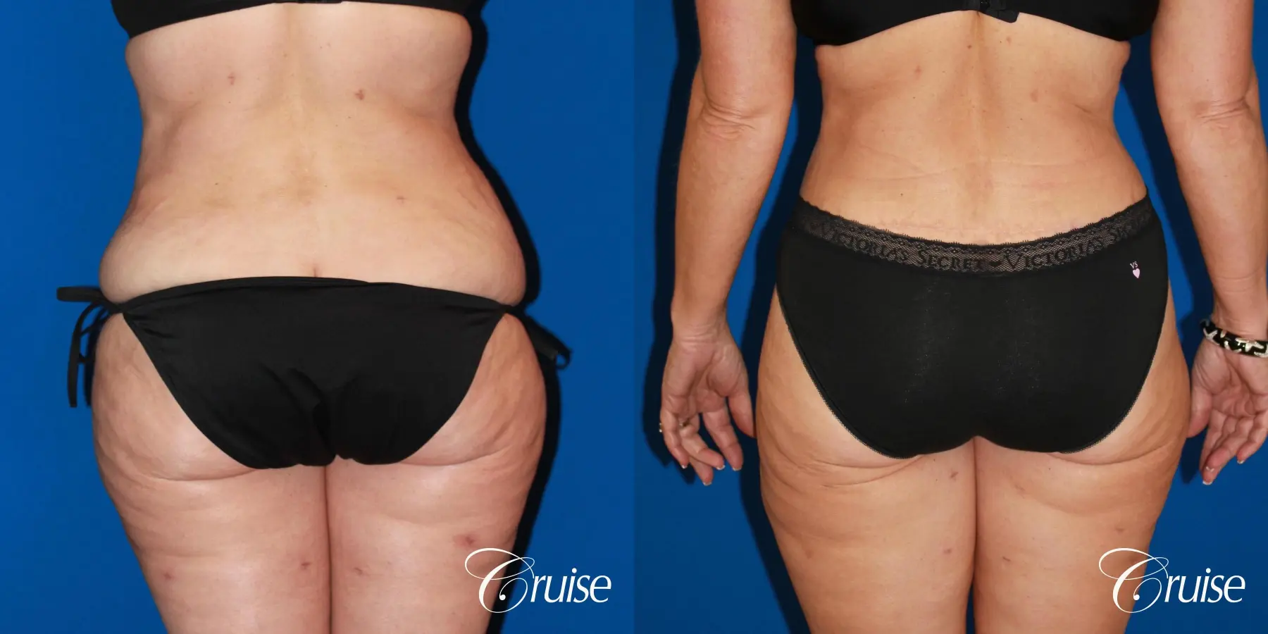 Tummy Tuck: Patient 80 - Before and After 6