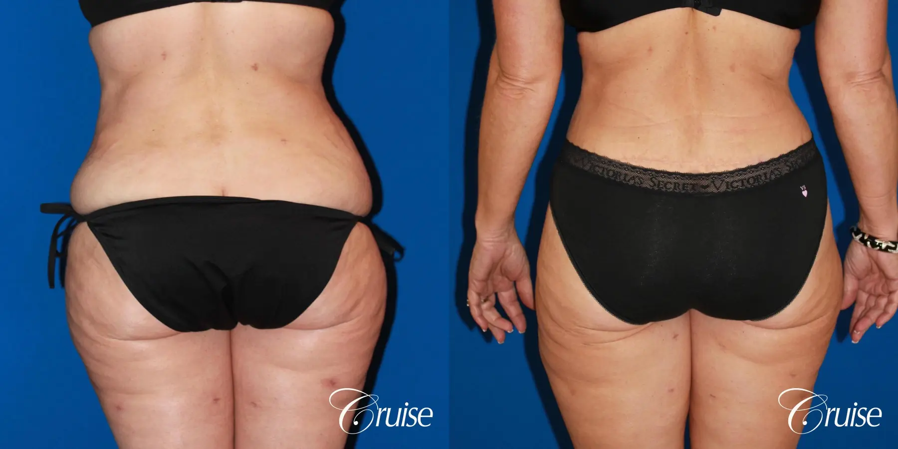 Tummy Tuck: Patient 86 - Before and After 6