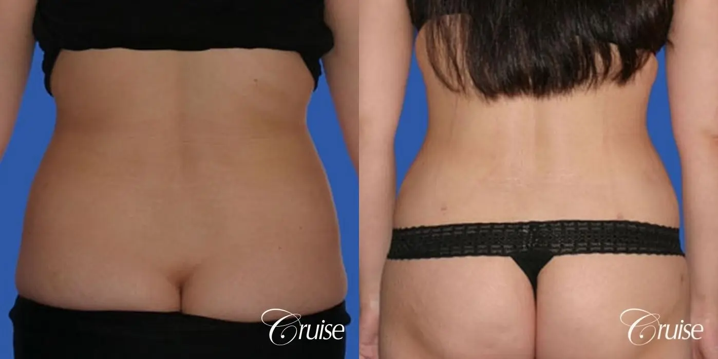 best standard tummy tuck abdominoplasty - Before and After 3