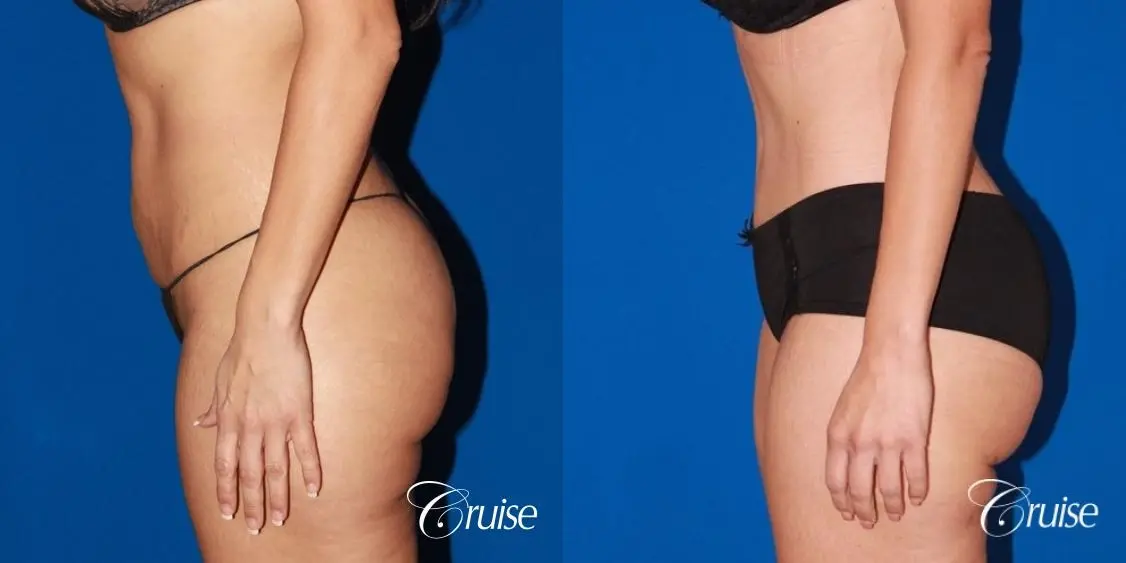 Tummy Tuck & Liposuction: 41 Yr Old Female  - Before and After 2