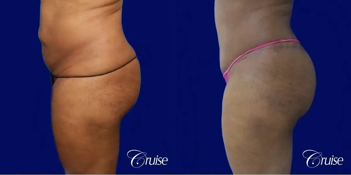 Tummy Tuck Extended Incision - Before and After 2